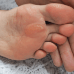 Ako odstrániť kurie oko bez bolesti: kompletný návod