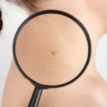 Papilómy na koži: čo to je a ako sa ich zbaviť prirodzene