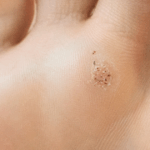 Prečo sa bradavice vracajú? (a ako tomu zabrániť raz a navždy)